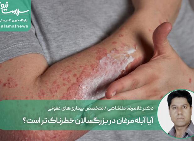 آیا آبله‌مرغان در بزرگسالان خطرناک‌تر است؟