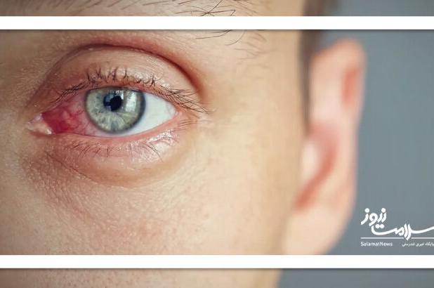 روش های کنترل خشکی چشم در زمستان