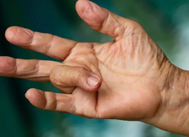 انگشت ماشه‌ای: علت، علائم و روش‌های درمان این مشکل شایع