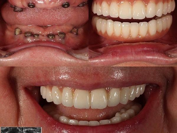 انواع ایمپلنت دندان از لحاظ نوع درمان، قرارگیری در استخوان فک و...