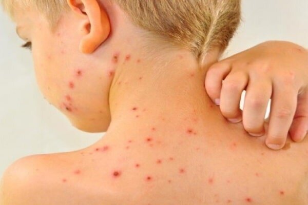 بالاترین میزان موارد ابتلا به سرخک در آمریکا از سال ۲۰۰۰ تاکنون