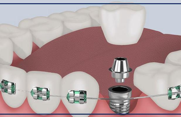 آیا میتوان همزمان با ارتودنسی ایمپلنت کاشت؟