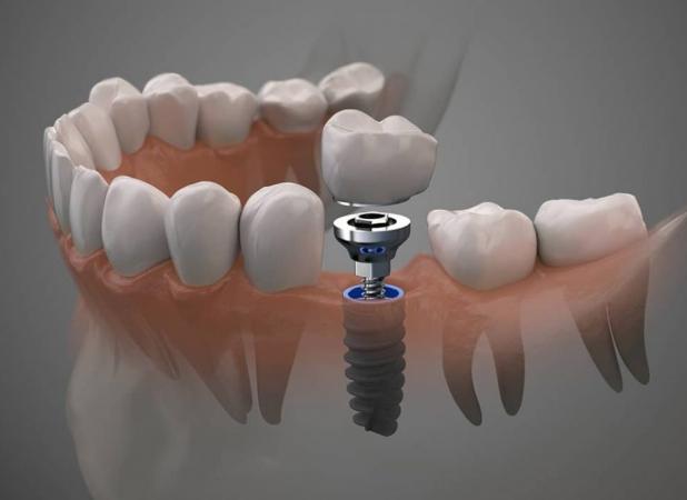 ایمپلنت دندان چیست؟ (بررسی کامل Dental Implant)