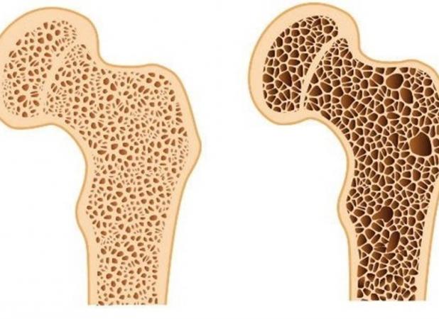 بهترین روش تشخیص پوکی استخوان/ دلایل ابتلا به بیماری