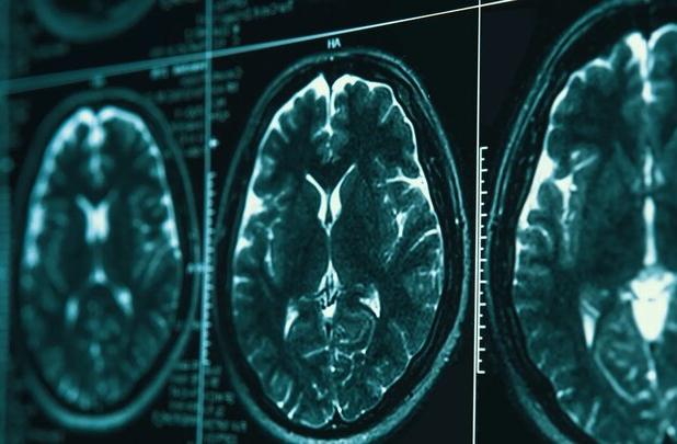 روشی در توقف بیماری آلزایمر کشف شد