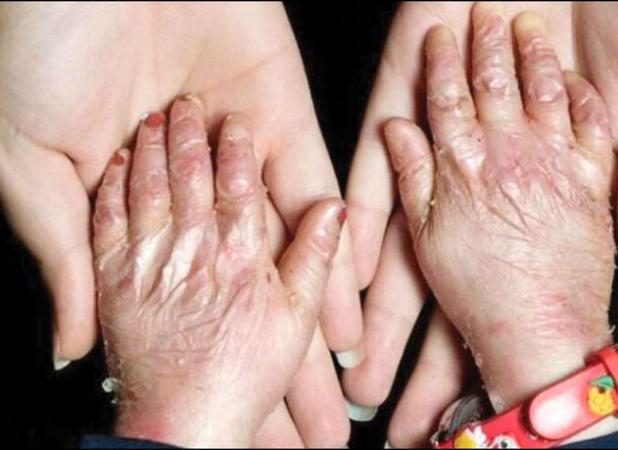 پمادهای حیاتی بیماران پروانه‌ای در ردیف محصولات آرایشی؛ هزینه‌های درمانی بالا و نیاز به اصلاح سیاست‌های بیمه‌ای