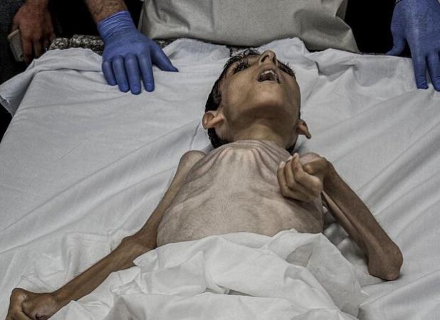 یک کودک دیگر فلسطینی در نتیجه سوء تغذیه جان داد