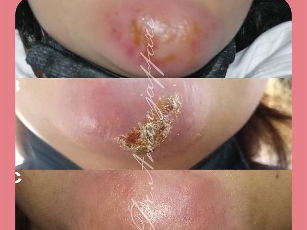 درمان نکروز بدون جراحی چگونه است؟