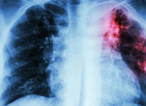 کشنده‌ترین بیماری عفونی جهان اعلام شد