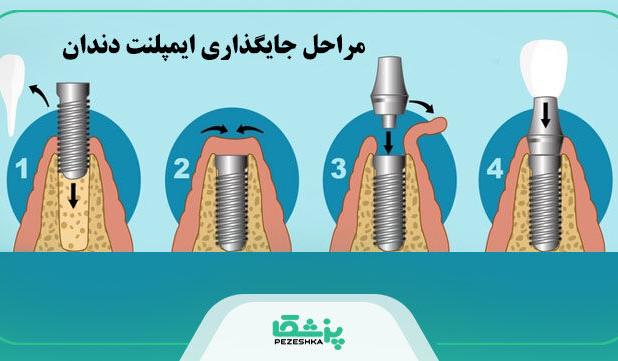 قیمت ایمپلنت دندان در سال 1404 + جدول هزینه انواع برندها【سال1404】