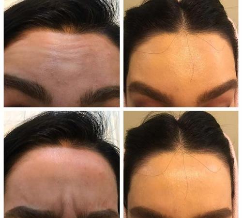 ۸ توصیه برای بوتاکس اولی‌ها که باید بدانید