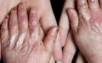 3 میلیون بیمار نادر در ایران؛ مشکلات درمانی و اجرایی سند ملی بیماری‌های نادر