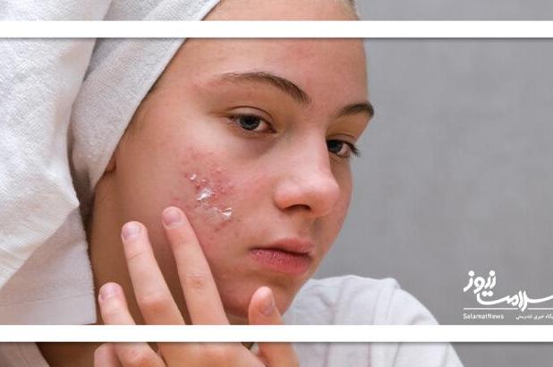 ۵ ترفند مراقبت از پوست برای مقابله با آکنه در فصل سرما