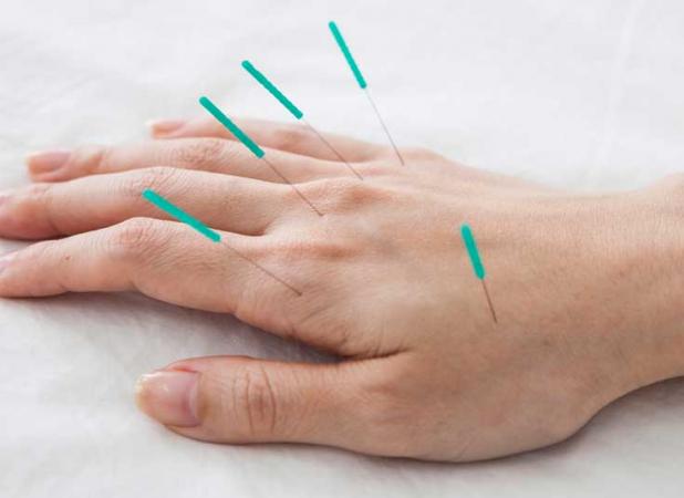 طب سوزنی درکاهش سردردهای تنشی موثر است