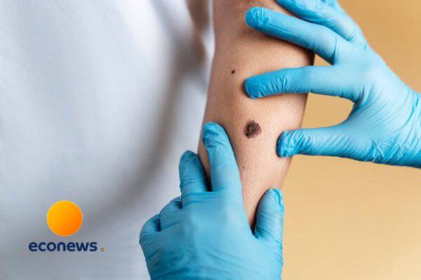  نتایج موفق تست داروی ضد سرطان پوست ایرانی