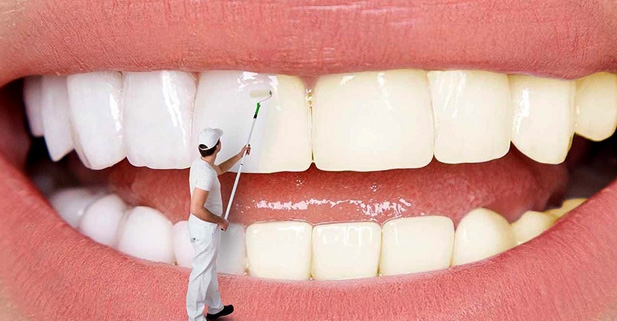 بلیچینگ دندان و لمینت دندان چه تفاوت هایی دارند؟