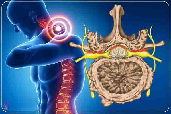  موفقیت جراحان شیرازی در عمل تومور نخاع گردنی