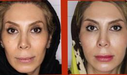 روش‌های لیفت و جوانسازی صورت؛ بدون جراحی و بدون دستگاه