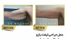 عمل لیفت بازو یا براکیوپلاستی چیست؟ + هزینه