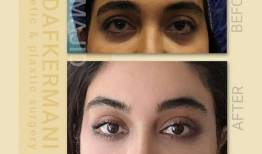 لیفت ﺍبرو چیست و چگونه انجام می‌شود؟ + هزینه