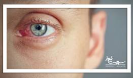 اورژانس خانگی مصدومین ستون فقرات و چشم