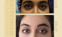 لیفت شقیقه چیست و چه روش‌هایی دارد؟