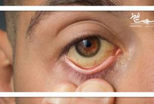 زرد شدن پوست نشانه زردی (یرقان) است؟