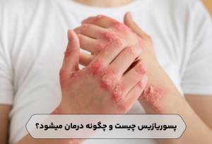 پسوریازیس چیست و چگونه درمان میشود؟