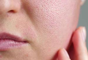 2 روش کارآمد برای کاهش منافذ باز پوست