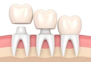 هزینه روکش دندان ۱۴۰۴ + لیست قیمت