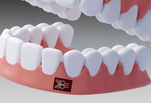 چسبی که التهاب در دهان را ردیابی می‌کند