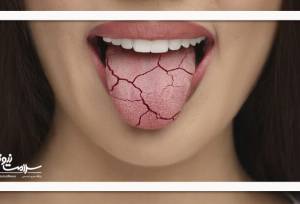 ۱۰ راه ساده برای خلاص شدن از خشکی دهان