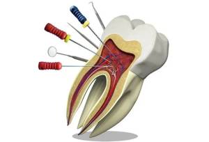 برای درمان ریشه و عصب کشی دندان چه ابزاری نیاز است؟