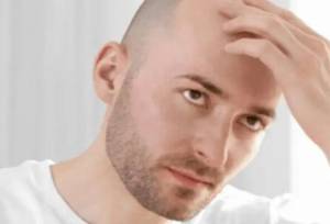 آشنایی با روش‌های کاشت مو