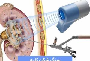 سنگ شکنی کلیه چیست و کدام روش واقعاً بدون درد و بی‌خطر است!