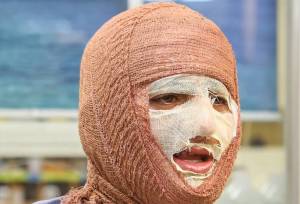 آیا بهبود کامل پس از سوختگی‌های عمیق امکان‌پذیر است؟