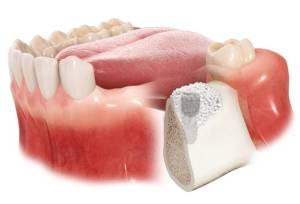 راهنمای جامع بازسازی استخوان فک برای ایمپلنت موفق