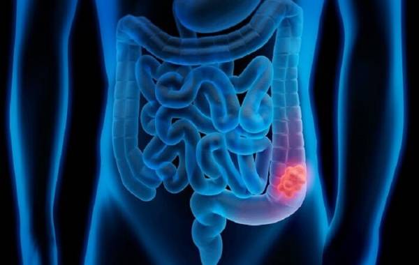  اقداماتی که خطر ابتلا به سرطان روده را کاهش می‌دهد