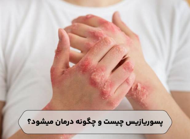 پسوریازیس چیست و چگونه درمان میشود؟