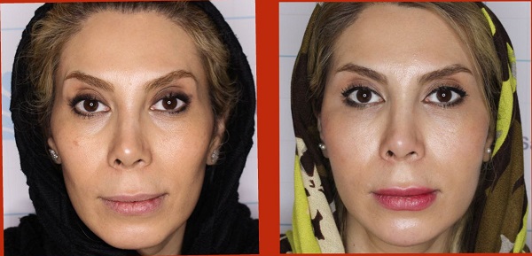 روش‌های لیفت و جوانسازی صورت؛ بدون جراحی و بدون دستگاه