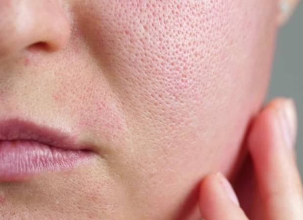 2 روش کارآمد برای کاهش منافذ باز پوست