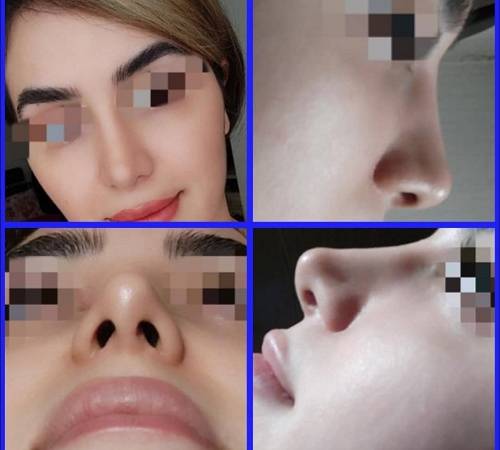 ترمیم بینی جراحی شده؛ چرا بینی شما نیاز به ترمیم دارد؟