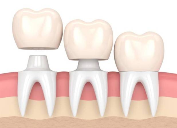 هزینه روکش دندان ۱۴۰۴ + لیست قیمت
