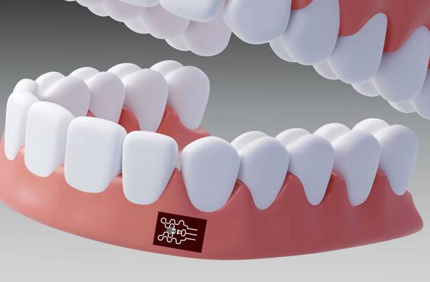 چسبی که التهاب در دهان را ردیابی می‌کند