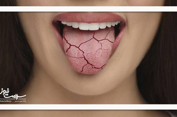 ۱۰ راه ساده برای خلاص شدن از خشکی دهان