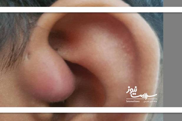 باورهای غلط درباره جرم‌گیری گوش