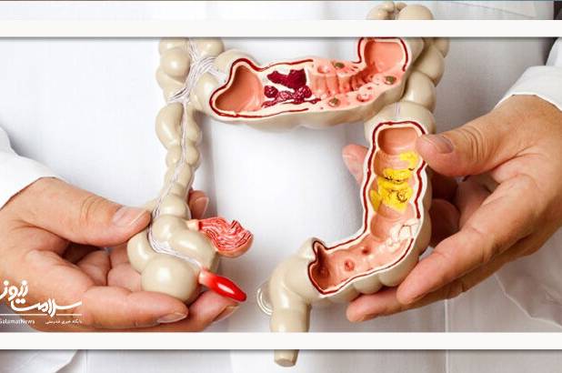 تاثیر استرس و اضطراب بر بیماری روده تحریک‌پذیر (IBS)