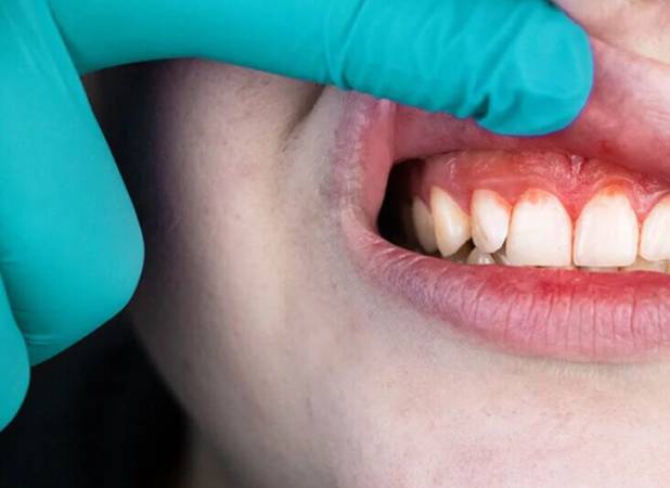 تشخیص التهاب لثه فقط با یک برچسب!