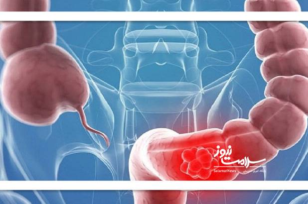 این تغذیه خطر ابتلا به سرطان روده را افزایش می‌دهد