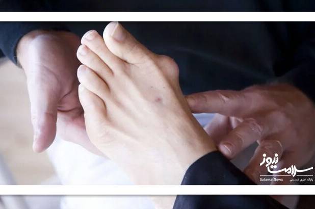 آیا می‌توان انحراف شست پا (بونیون) را بدون جراحی کمتر کرد؟